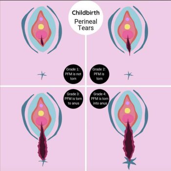 Diagram showing grades of perineal tears including grade 1, grade 2, and OASIS, with and without pelvic floor muscle involvement